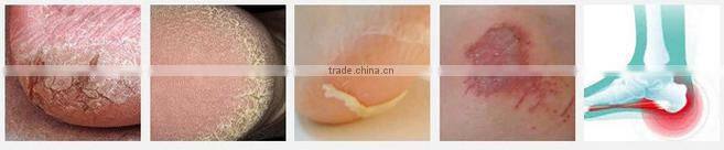 silicone gel heel and ankle sleeve cushion pad silicone socks for shoe heel protector