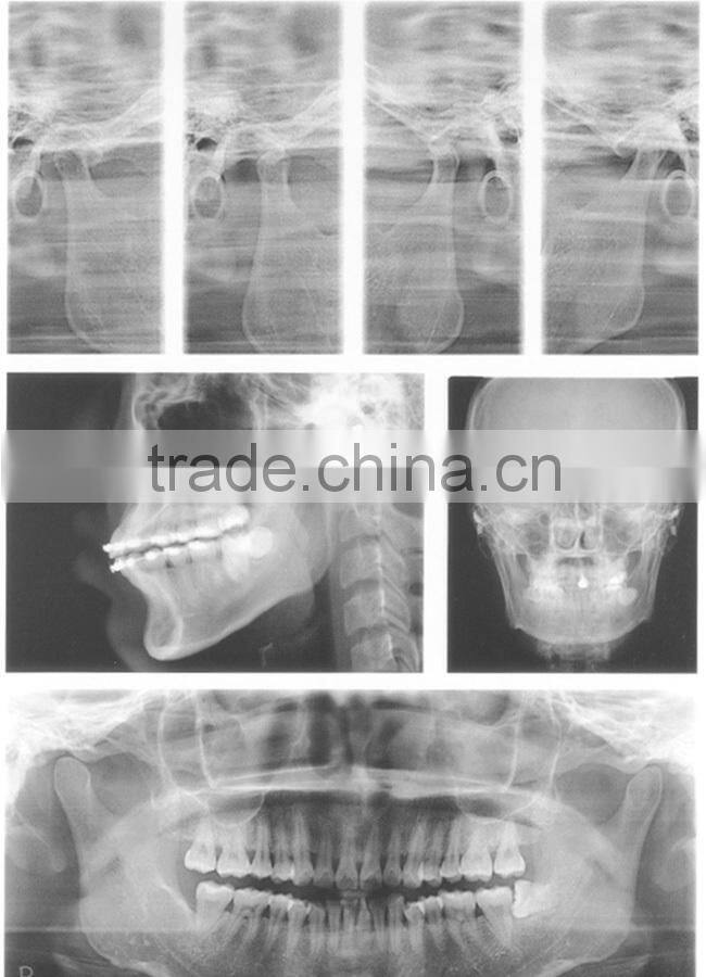 China Dental Supply Digital Panoramic X-ray Equipmeng with Toshiba X-ray tube XR-91