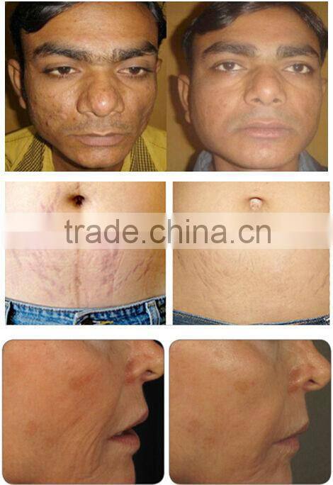 2015 bipolar rf fractional microneedle face lift machine CE