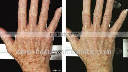 Beauty & Personal Care ipl equipment acne removal