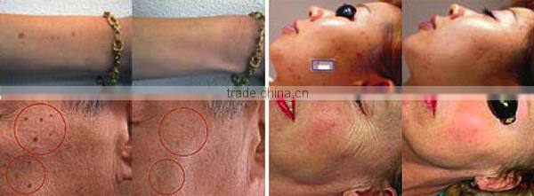 New shr ipl equipment for distributor Vertical IPL SHR&E-light hair removal equipment&machine