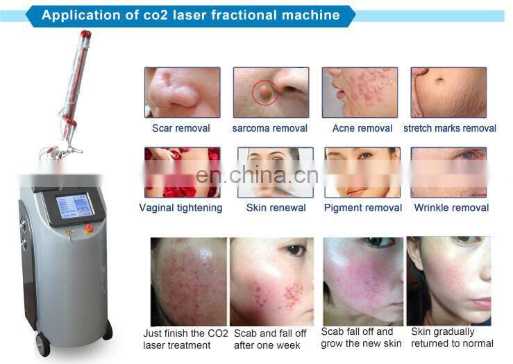 2018 hot selling 40W deep renu elite fractional co2 laser for stretch mark and scar removal