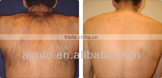 Apolomed 808 diode laser hair removal machine skin rejuvenation laser diode