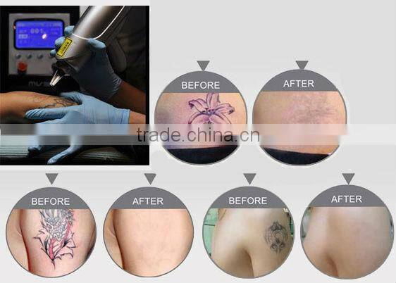 Q switch laser machine, nd yag treatment head 1064nm 532nm machine