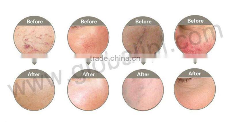 Diode laser vascular removal machine!!! Age spots vascular lesions portable vascular doppler