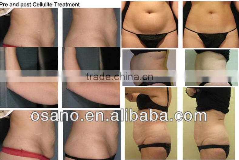 2016 Newest 4 Handles China Beauty Spa Use Portable Cryolipolyse Machine For Home Use