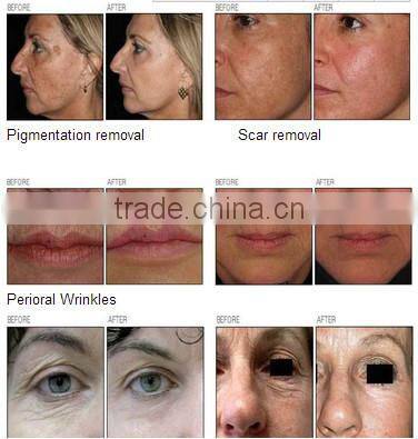 Portable Radio Frequency Beauty Slimming Machine For Facial