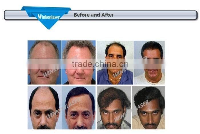 hair regrowth machine/fast hair regrowth/laser hair regrowth machine