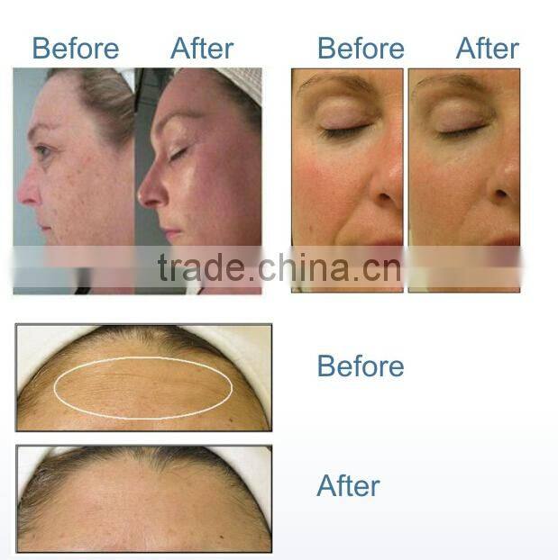 2015 New microcurrent skin tightening machine skin toning therapy