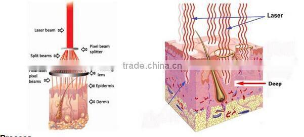 Powerful 60W medical fractional co2 laser scar removal machine/CO2 Carboxy therapy