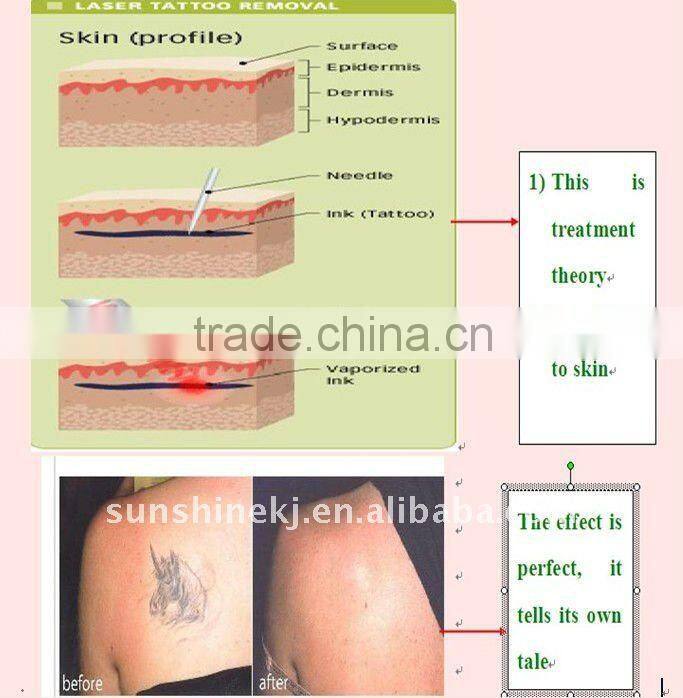 tattoo removal laser mobile spa equipment for tattoo removal