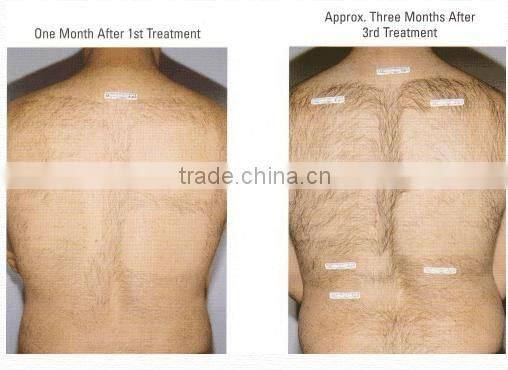 E-light remove hair/spots/red capillary/acne beauty machine