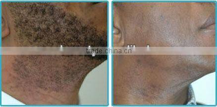 P001 professional wholesale laser hair removal epilation with long pulse 1064nm