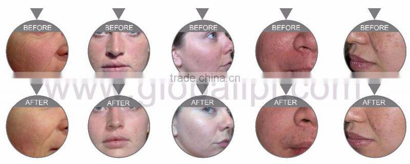 Oxygen water facial skin care jet peel facial equipment wholesale