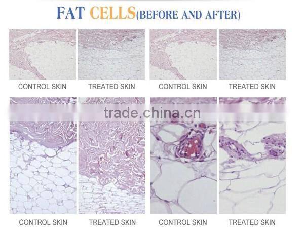 HOT lipolaser body laser slimming machine SW-L90 with ISO and CE certificate