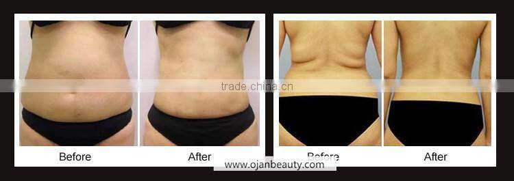 Hifu liposonix body slimming machine CE MX-LS1