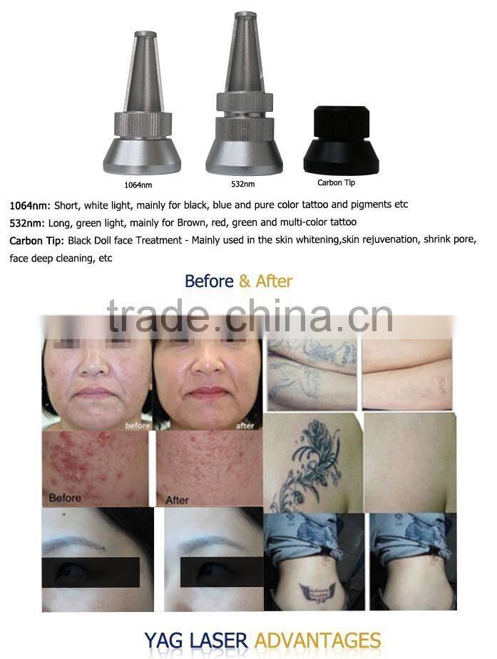 2015 Newest! nd yag laser tattoo removal machine