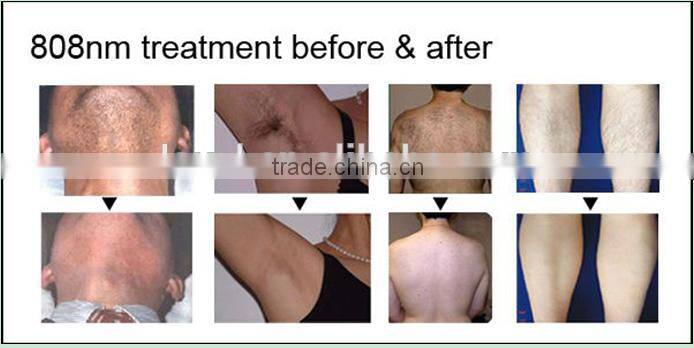 new products on china market portable 808nm diode laser skin hair removal ipl machine