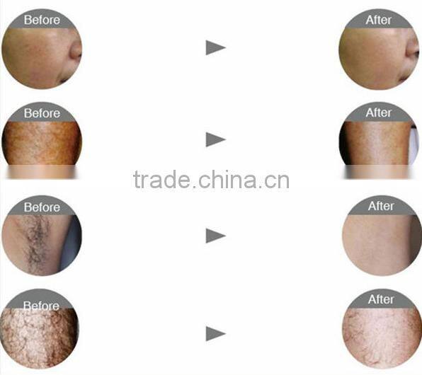 Powerful Portable Best China Portable SHR IPL aft Machine for hair removal skin rejuvenation