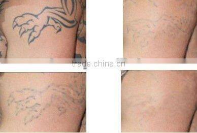 ND yag 1064 laser for pigment freckle and spots removal machine D006