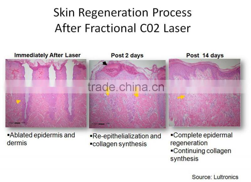 Professional CO2 Fractional Laser Machine For Women Skin Resurfacing POP IPL FC10