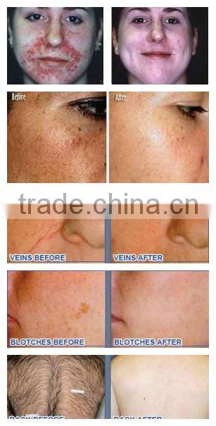 Super hair removal ipl machine made in germany with top quality