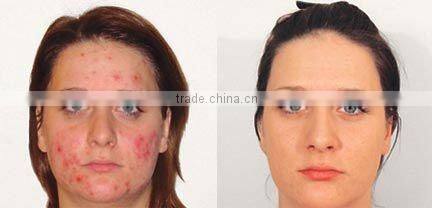 Popular PDT/LED skin rejuvenation machine G004