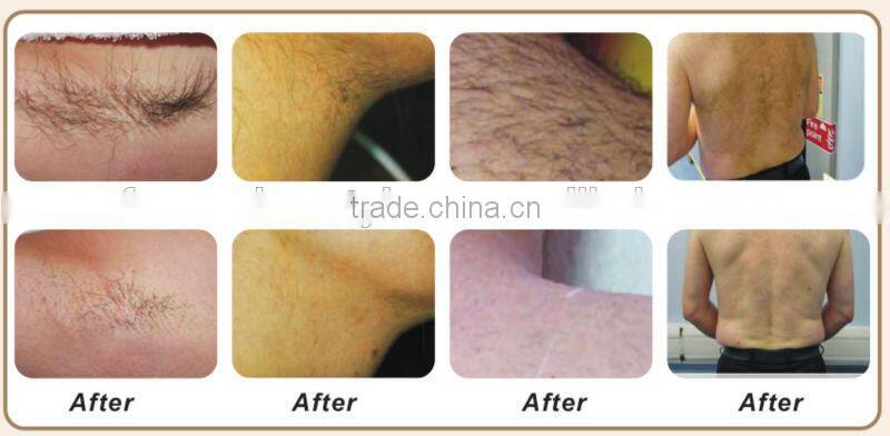 Magic Effects Pain Free 808nm Diode laser permanent painless hair removal(DIDO-III)