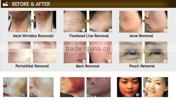 Hot sale Dermaroller Titanium 40 needles Stamp Skin Roller microneedling dermaroller