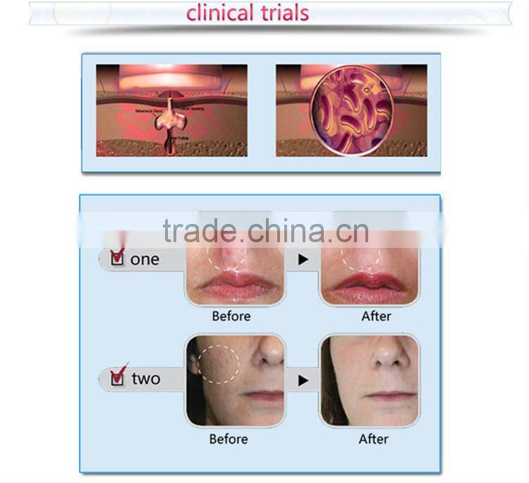 economic acne removal black head white head removal machine for sale