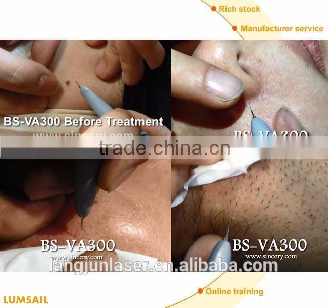 Beautiful Professional Cure Telangiectasia Treatment Vein Removal Equipment