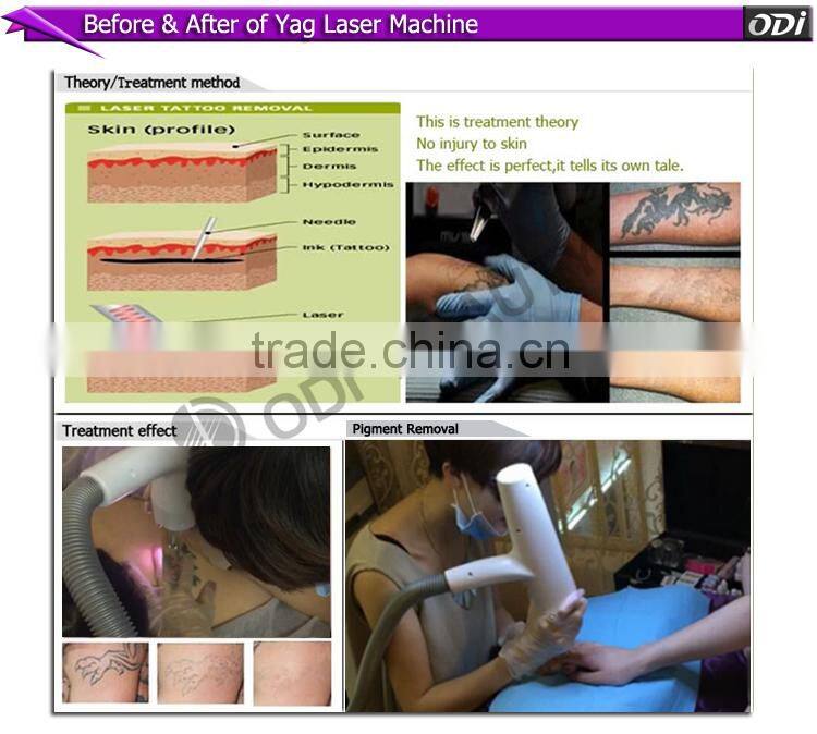 OD-LS900 Strong and fast eyebrow tattoo removal yellow robs yag crystals laser