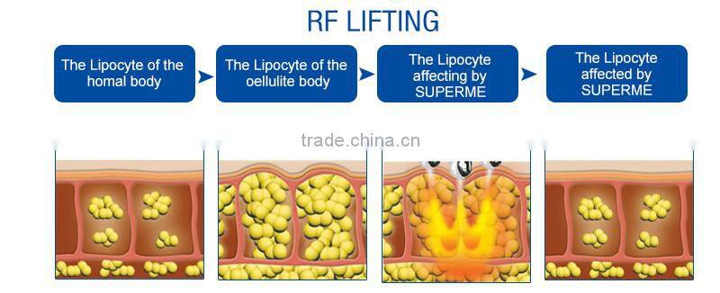 Most advanced IPL SHR Nd yag machine