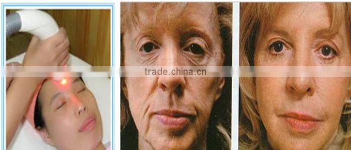 hair removal espil ipl rf elight beauty machine nd yag