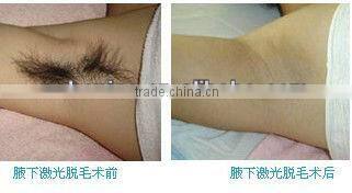 2015 Promotion ! 808nm laser diode/ professional laser hair removal machine/808nm diode laser with CE