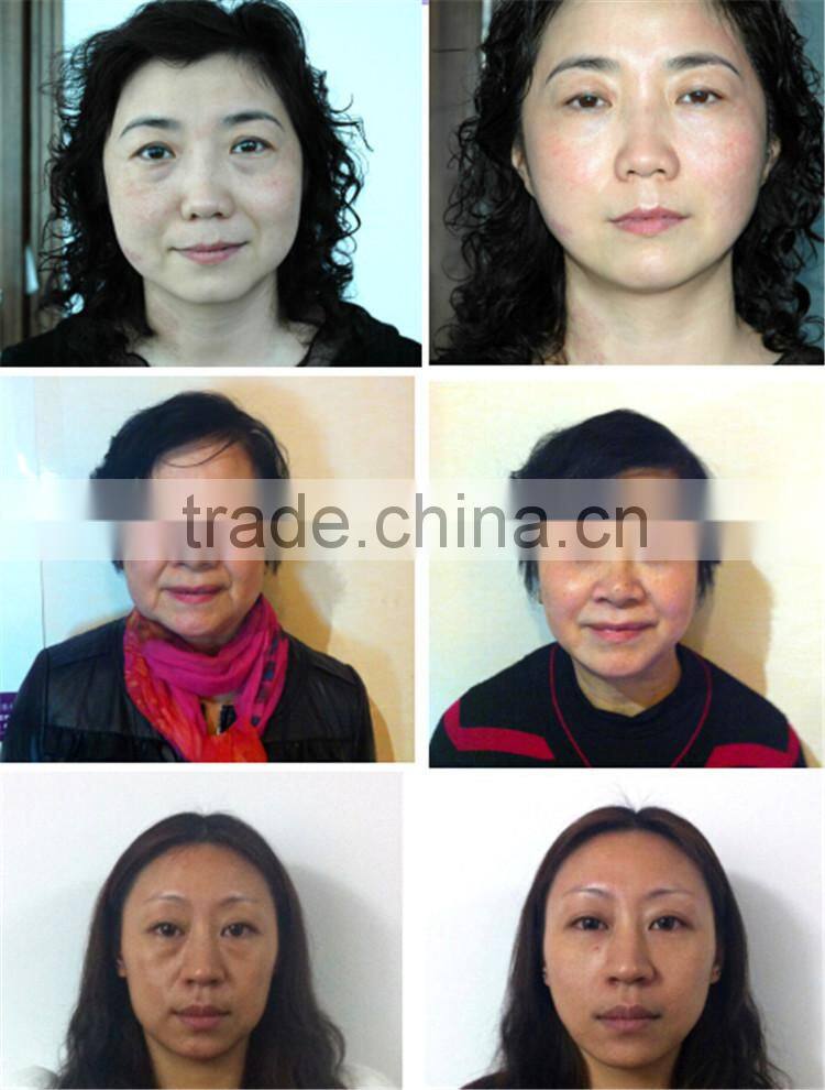 portable rf skin tightening machine wrinkle removal