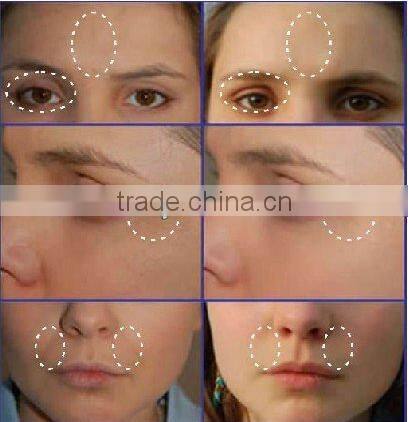 Discount!!!professional face lift RF beauty equipment