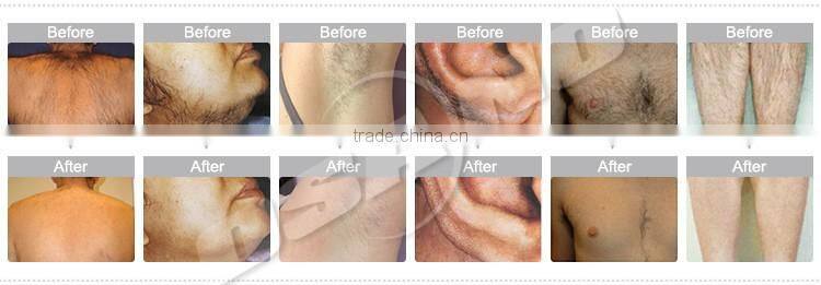 LM-E20 IPL machine for Tri cooling system ipl&rf beauty salon equipment