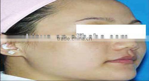 1064nm&532nm Q-switch Nd:YAG laser machine