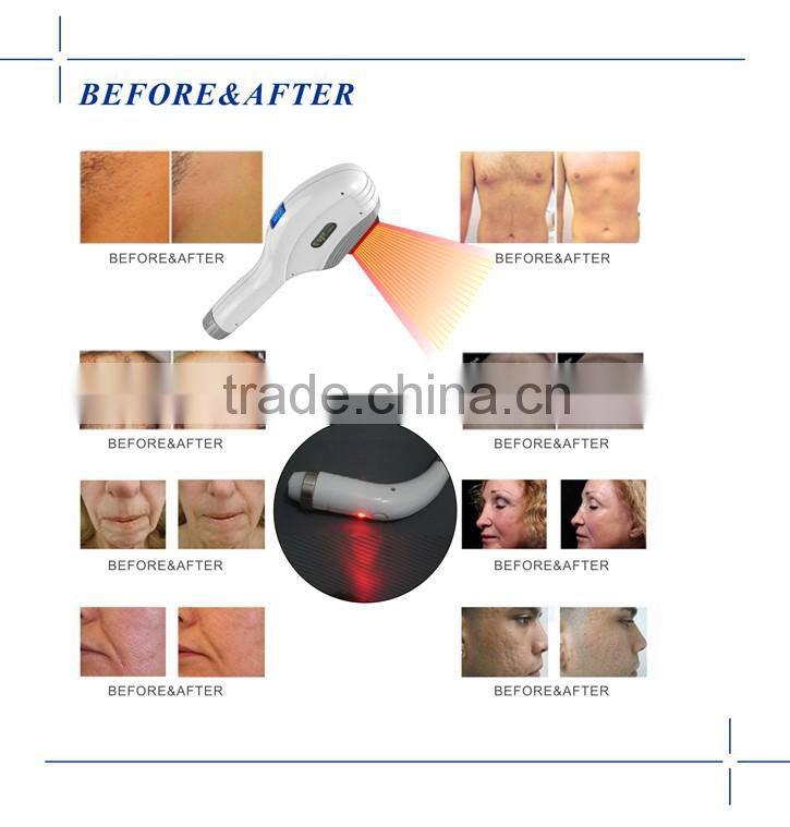 High Quality Two Handpeces IPL RF With CE Approved