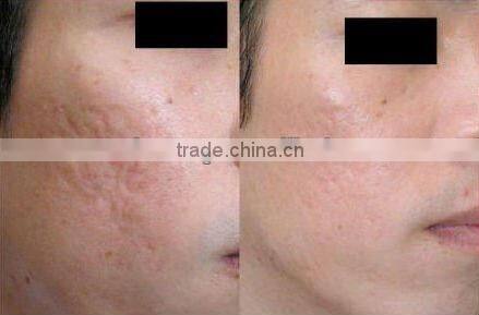 High cost-effective shrink pores mym electric dermo pen EL011