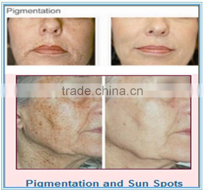 Q- Switched Nd YAG Laser tattoo removal Machine