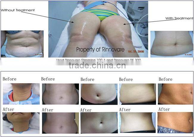 Kumashape vacuum liposuction roller massage cellulite removal machine