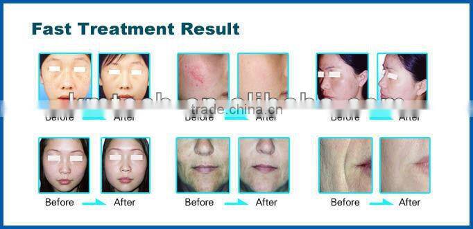 elight beauty machine china new innovative product