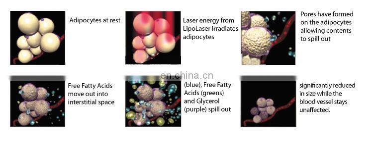 portable weight loss liposuction machine  lipo laser wavelength 650nm 980nm