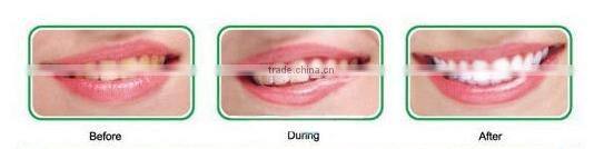 Hot selling teeth whitening with high quality