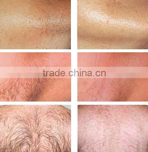 Best selling ipl photofacial machine / portable hair removal machine good effect ipl beauty machine ICE 1