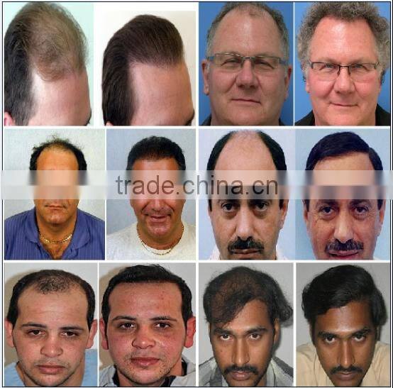 fast hair regrowth / soft laser therapy device / laser hair therapy machine