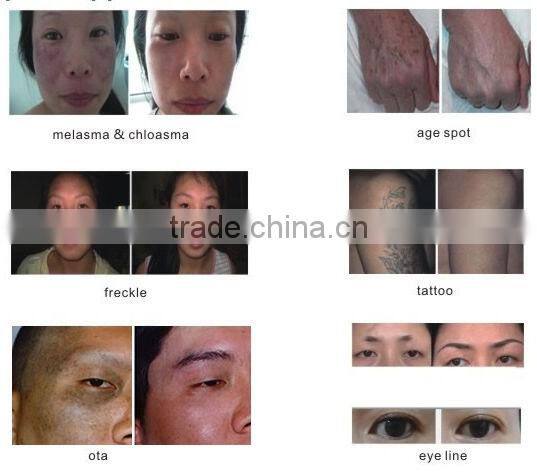 Nd:yag Q-switch pigment arm tattoo removal laser