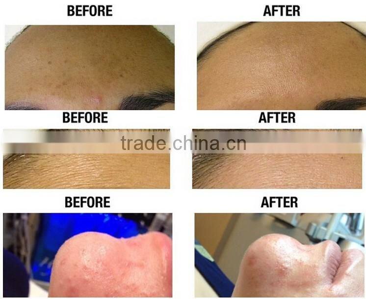 NL-SPA13 Mini water dermabrasion machine for sale Skin Rejuvention Vacuum for sale